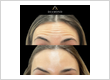 botox treatment 