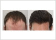 Rahal Hair Transplant