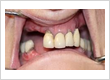 dental implants provider near me