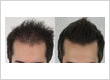 Rahal Hair Transplant